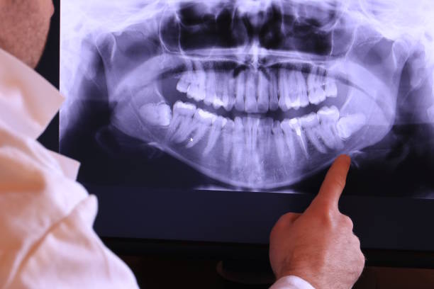 Best Emergency Wisdom Teeth Removal in Central, TN