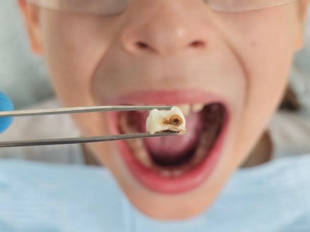 Best Emergency Tooth Extraction in Central, TN
